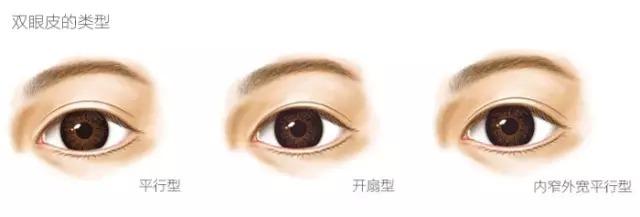 整形小知識(shí)多圖告訴你：雙眼皮怎么割