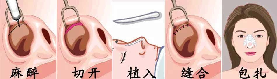 隆鼻手術(shù)后有哪些后遺癥呢？