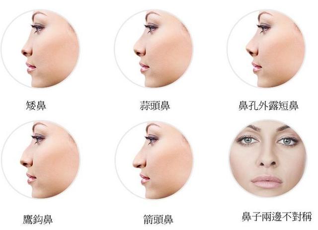 隆鼻手術(shù)后有哪些后遺癥呢？