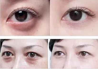 全球熱銷1000萬支！只要120秒去眼袋！從史泰龍老婆火到中國的！